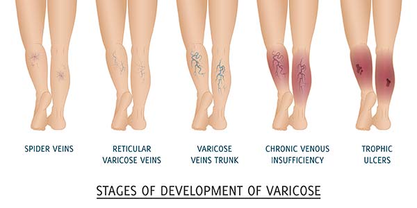 Stages of development of vericose: spider veins, reticular vericose veins, vericose veins trunk, chronic venous insufficiency, trophic ulcers